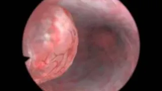 Diagnostic Hysteroscopy - VirtaMed Virtual Reality Simulation for Endoscopic Surgery