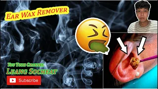 Best Ear Wax Remover! Blockage Can't Hear. Ep.#5