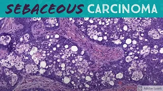 Sebaceous carcinoma (ddx: basal cell carcinoma & basaloid squamous cell carcinoma)