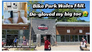 Bike Park Wales Fail! De-gloved my big toe & missed two track days (WARNING Contains gory footage)