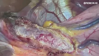 Ахалазия кардии  Лапароскопическая экстрамукозная кардиомиотомия с пластикой стенкой желудка