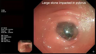 ENDOSCOPIC MANAGEMENT OF BOUVERET’S SYNDROME