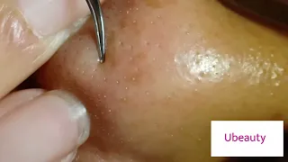 No squeezing whiteheads removal (Facial 40)