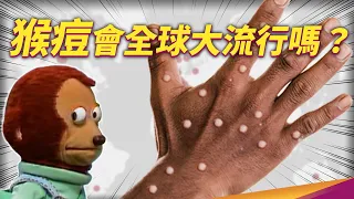 台灣本土猴痘進來了！ 「人傳人」症狀、傳染途徑有哪些？沒疫苗那有藥醫嗎？