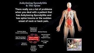 Ankylosing Spondylitis & The Spine - Everything You Need To Know - Dr. Nabil Ebraheim