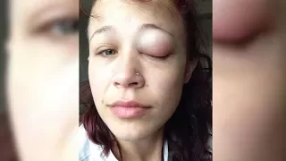 Ottawa woman warns others after botched eye tattoo