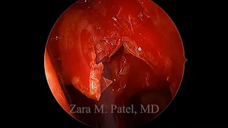 Endoscopic Sinus Surgery