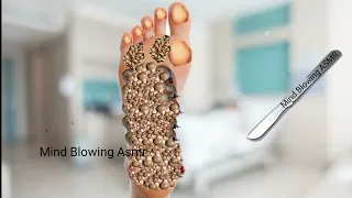 ASMR maggot infected foot , remove dog ticks & pustules / asmr