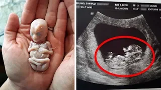 Mutter bringt Baby zur Welt, 6 Wochen später finden Ärzte ungeborenen "Zwilling"
