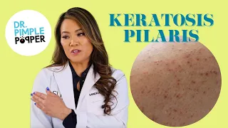 Ask Dr. Pimple Popper | Keratosis Pilaris aka 'Chicken Skin'