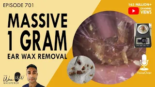 701 - Massive 1 Gram Ear Wax Removal