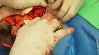 Extended Deep Plane Facelift Surgical Video