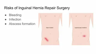 Inguinal Hernia Repair Surgery, Risks and Outcomes - CHI Health