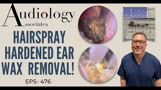 HAIRSPRAY HARDENED EAR WAX REMOVAL - EP476