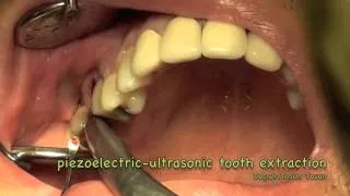 extraction by piezoelectric-ultrasonic surgery