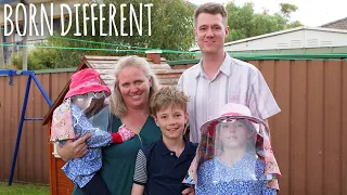 We Are Allergic To Sunlight | BORN DIFFERENT