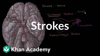 Strokes | Miscellaneous | Heatlh & Medicine | Khan Academy