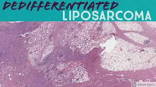 Dedifferentiated liposarcoma (with heterologous osteosarcoma component)