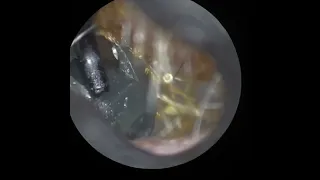 09 - Hearing Dome extracted with Ear Hook using WAXscope®️