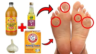 14 Proven Home Remedies For Corns & Callus Removal THAT WORK!