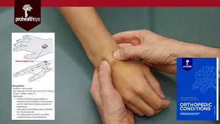 Ganglion Cyst of Wrist Diagnosis and Treatment Dr Vizniak