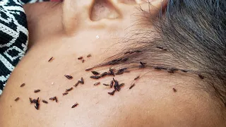 Getting out all thousand lice from hair - Remove all hundred lice from hair