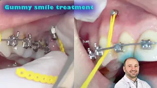 TADs(mini implants) to correct the gummy smile without surgery and to fix sever deep bite & class 2