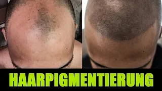 Mikro Haarpigmentierung - Alternative zur Haartransplantation?