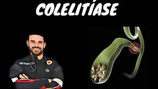 COLELITÍASE