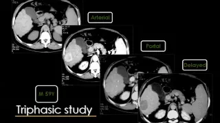 Imaging of the Liver   DRE 8   Dr Mamdouh Mahfouz 720p