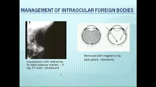 A Class On INTRAOCULAR FOREIGN BODIES,CHEMCAL INJURIES By Dr Vivekanand Dept Of Ophthalmology