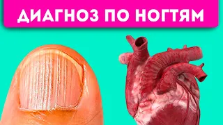 Маникюр не спасет! 8 проблем с ногтями, которые укажут на сердце, легкие, желудок и даже …