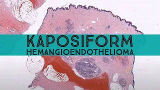 Tufted angioma/Kaposiform Hemangioendothelioma (pathology dermpath dermatology dermatopathology)