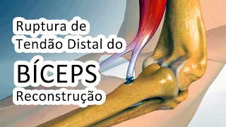 Ruptura de Tendão Distal do Bíceps - Reconstrução Cirúrgica