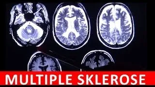 Multiple Sklerose MS Autoimmunerkrankung des Zentralnervensystems in MRT Aufnahme by Radiologie TV