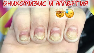 Difficult case 😰 Allergy to gel polish 🤯 Onycholysis of nails