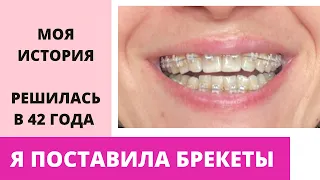 Я ПОСТАВИЛА БРЕКЕТЫ. МОЯ ИСТОРИЯ.