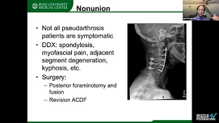 9   Revision Cervical Spine Surgery  Pseudarthrosis & Cervical Deformity   Howard S  An, MD