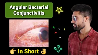 Angular Bacterial Conjunctivitis lecture opthalmology