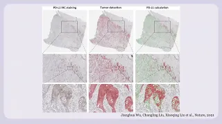 Student video: Can AI Replace IHC for PD-L1?