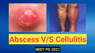 Brief Discussion On Pyogenic Abscess And Cellulitis | General Surgery| NEET PG 2021