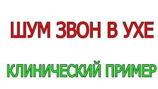 Тиннитус Шум звон свист в ушах голове, СПА ? Клинический пример Лечение