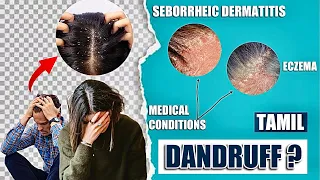 Complete guide to cure dandruff ! | Tamil | Kaviarasan raj