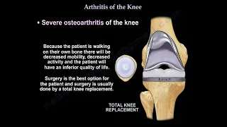 Knee arthritis, causes,  symptoms, diagnosis  and treatment