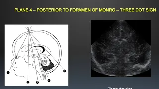 TMT: Neurosono by Dr Mrudula Bapat : Basic Anatomy & Scanning Technique