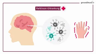 Was ist die Parkinson-Erkrankung?