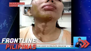 Magkapatid, sinabuyan ng asido ng 'di pa kilalang suspek