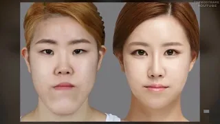 Чудо корейские хирурги. Пластическая хирургия до и после
