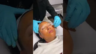 VI Peel for Acne Scars, Textured Skin, Wrinkles, Sun Damage & More!