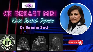 CE BREAST MRI || DR SEEMA SUD | Enhancement Patterns | Carcinoma Breast #cabreast #mriteachingcourse